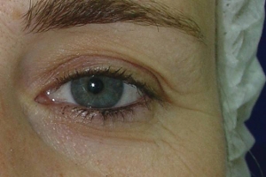 oko pred operaci